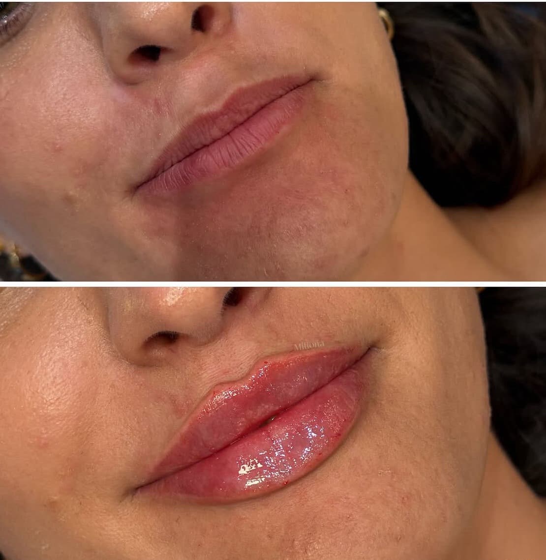 Lip Filler: Everything You Should Know 1