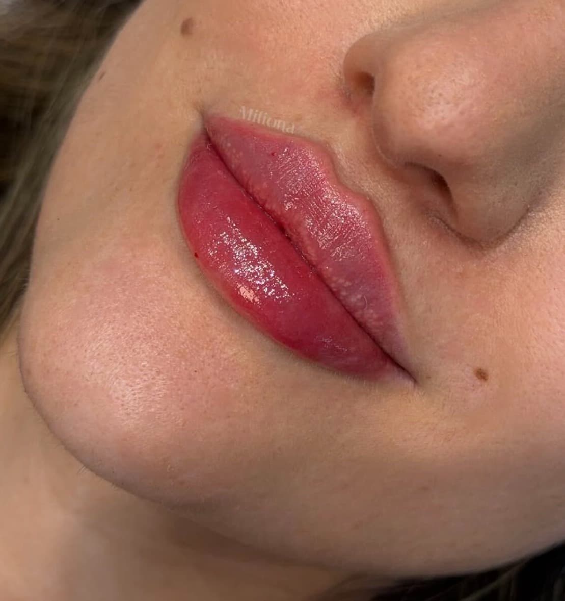 Lip Filler: Everything You Should Know 2