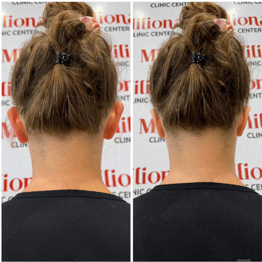 OTOPLASTY 2