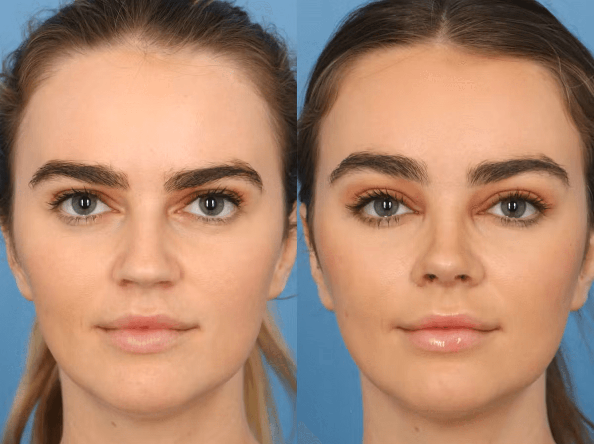 BROW LIFT 1