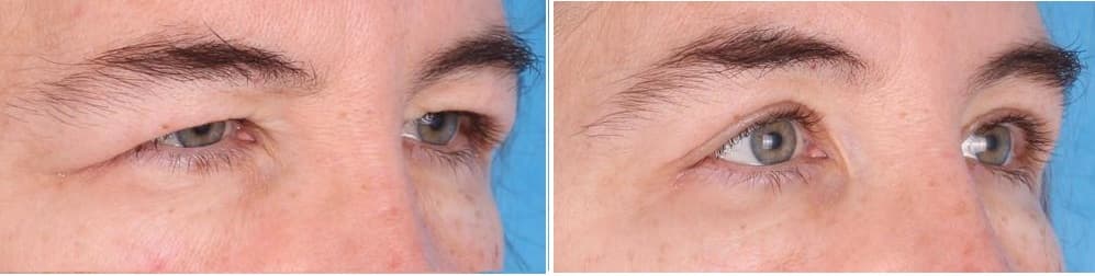 BLEFAROPLASTIKK 1